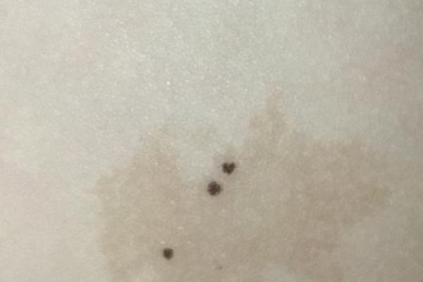 腰部上的胎记如何算命分析？