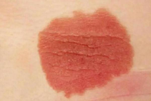 额头胎记算命